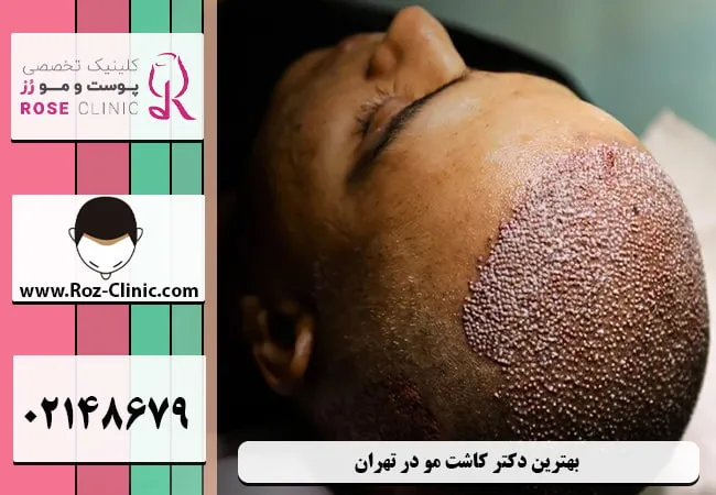 کاشت مو تهران