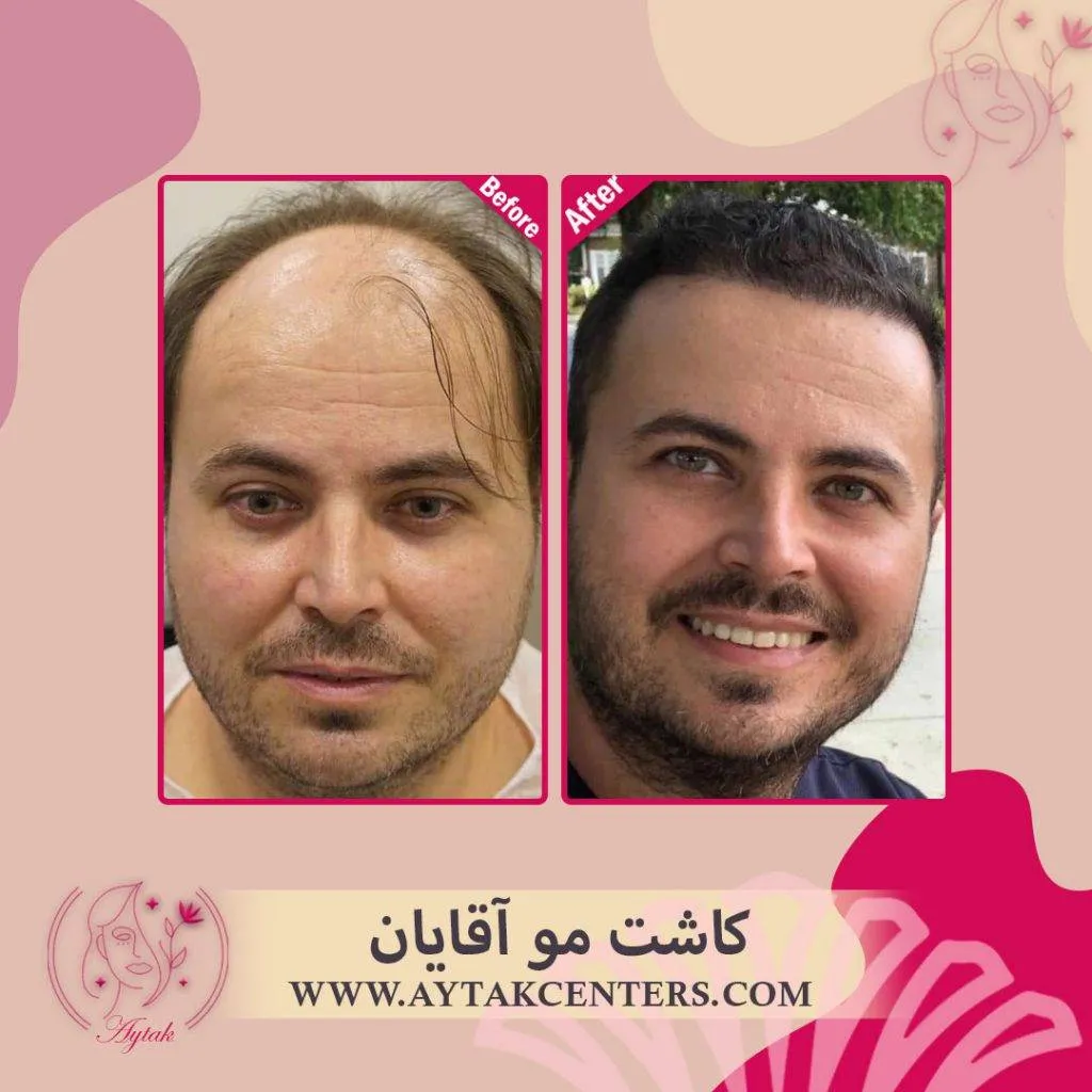 کاشت مو