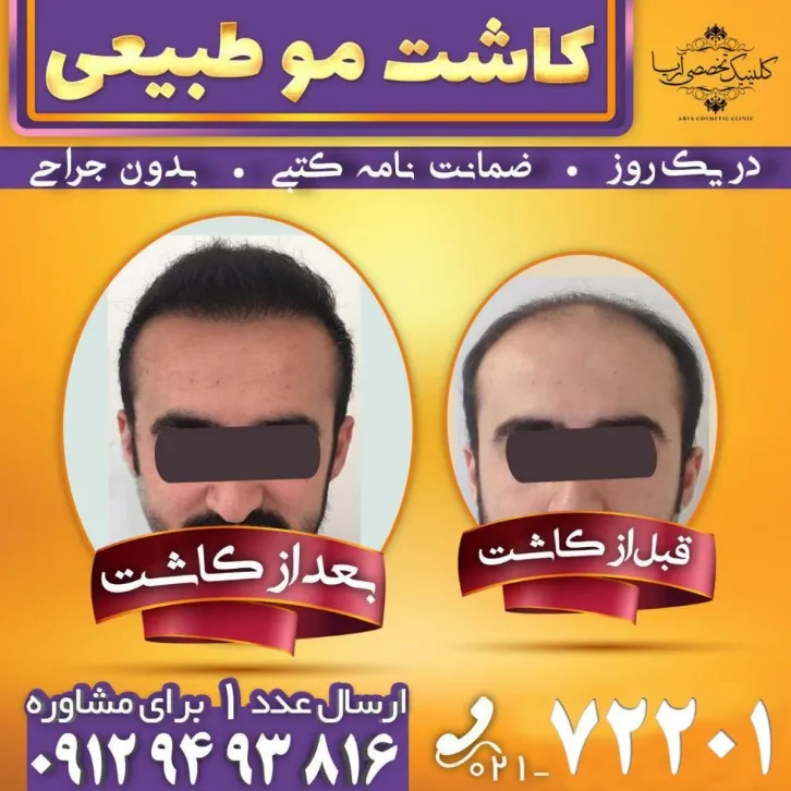 کاشت مو